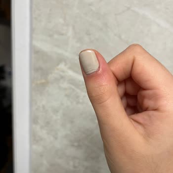 Gratis Beauty Manikür Sonrası Tırnağımın İltihap Kapması