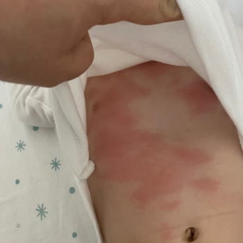 Mustela Stelatopia Şampuan Kullanım Sonrası Egzama.