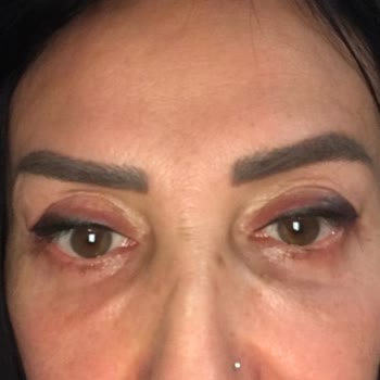 Liva Clinic Gözaltı Torbası Ameliyatı