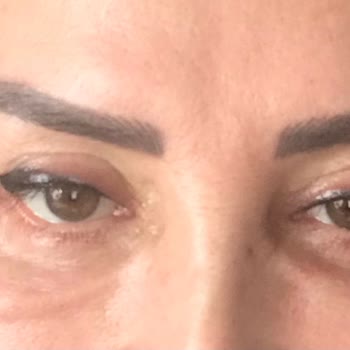 Liva Clinic Gözaltı Torbası Ameliyatı