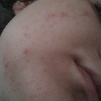 She Vec Cosmetic Hi Girls Bye Pores Serum Yüzümde Kırmızı Kabarcıklar Ve Kaşıntı Yaptı