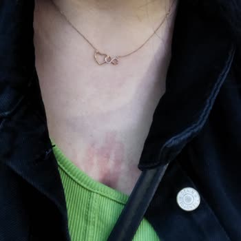 Black Diamond Beauty (Pursaklar) Lazerde Yakıldım, Kalan Seanslarım İptal Edildi