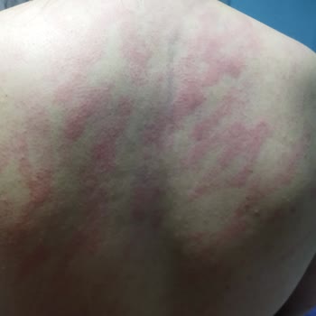 Black Diamond Beauty (Pursaklar) Lazerde Yakıldım, Kalan Seanslarım İptal Edildi