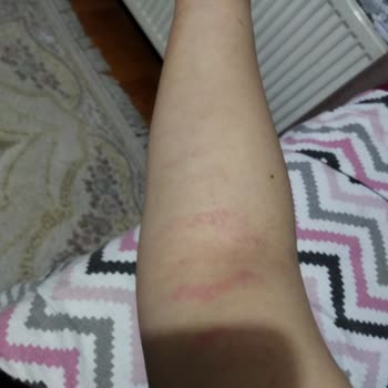 Black Diamond Beauty (Pursaklar) Lazerde Yakıldım, Kalan Seanslarım İptal Edildi