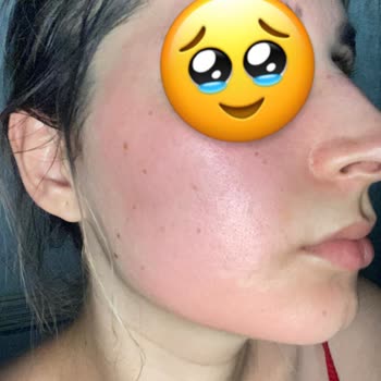 SHE Vec Glyc Alright Tonik Yüzümü Yaktı