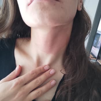 Eyüp Sabri Tuncer Vücudumda Epeyce Büyük Bir Kızarıklık