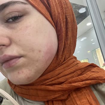 Bakırköy Klinik Yüzümü Yaktı. Masater Botoks Sonrası Gülemiyorum