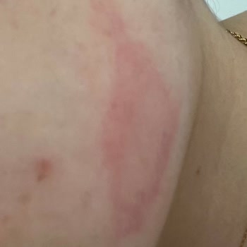 Bakırköy Klinik Yüzümü Yaktı. Masater Botoks Sonrası Gülemiyorum