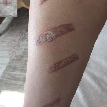 Innovation Güzellik Salonu (Çorlu) Lazer De Bacaklarımı Yaktılar.