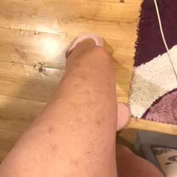 Novar Poliklinik Komple Bacağımı ve Genital Bölgemi Yaktılar