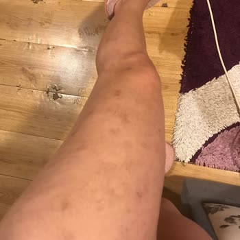 Novar Poliklinik Komple Bacağımı ve Genital Bölgemi Yaktılar