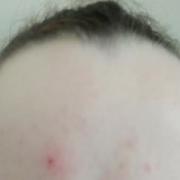 The Fine Organics Ürün Sivilce Yaptı