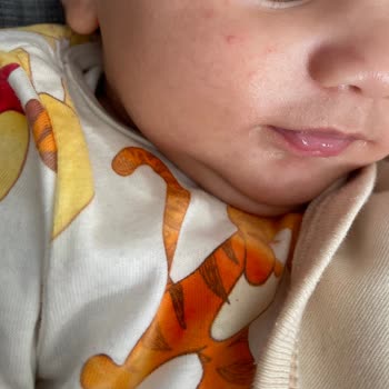 Bioderma Alerji Ciltte Kızarıklık