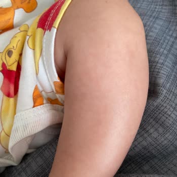 Bioderma Alerji Ciltte Kızarıklık