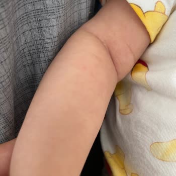 Bioderma Alerji Ciltte Kızarıklık