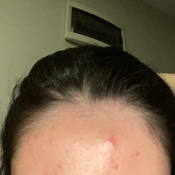 Vichy Akne Serisi Diye Satılan Ürün Daha Çok Akneye Sebep Oluyor