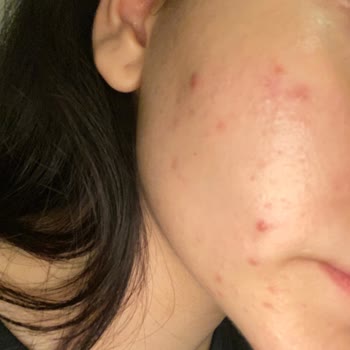 Vichy Akne Serisi Diye Satılan Ürün Daha Çok Akneye Sebep Oluyor