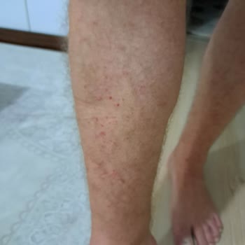 Nivea Güneş Kremi Korumasının Olmaması Ve Alerjik Reaksiyona Sebep