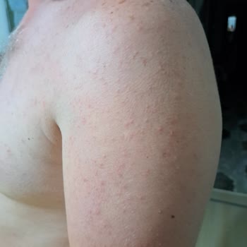 Nivea Güneş Kremi Korumasının Olmaması Ve Alerjik Reaksiyona Sebep