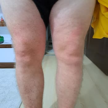 Nivea Güneş Kremi Korumasının Olmaması Ve Alerjik Reaksiyona Sebep