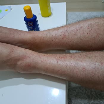 Nivea Güneş Kremi Korumasının Olmaması Ve Alerjik Reaksiyona Sebep