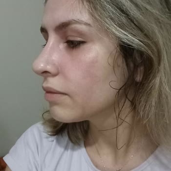 Neutrogena Ürünü Yüzümü Yaktı