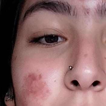 Dr. Ayşegül Saltat Kliniği Kızıma İşlem Yaptılar Yüzünde Yanık İzleri Oluştu