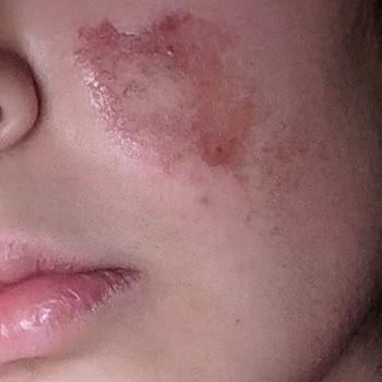 Dr. Ayşegül Saltat Kliniği Kızıma İşlem Yaptılar Yüzünde Yanık İzleri Oluştu