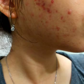 Mr. Emir Beauty Center Hala Akne Problemleri İle Uğraşıyorum