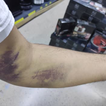 Türk Kızılay Kan Verdim Kolum Morardı