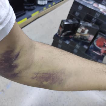 Türk Kızılay Kan Verdim Kolum Morardı