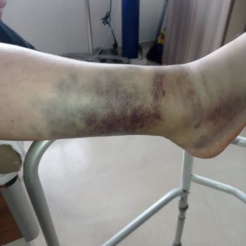 Gebze Fatih Devlet Hastanesi Yanlış Tanı Sonucu Ayakta Kangren