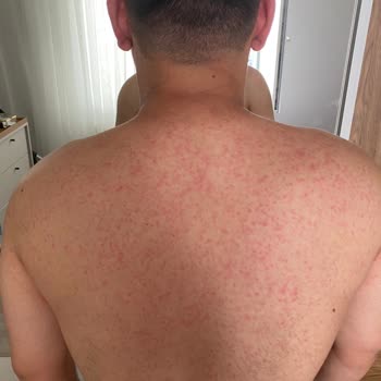 Abdi İbrahim Factive 320 Mg Yan Etkisi