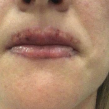 Şebnem Erdağ Beauty Center Dudak Renklendirme Mağduriyeti