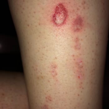 Philips Lumea Brı950 Bacağımı Yaktı