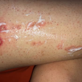 Philips Lumea Brı950 Bacağımı Yaktı