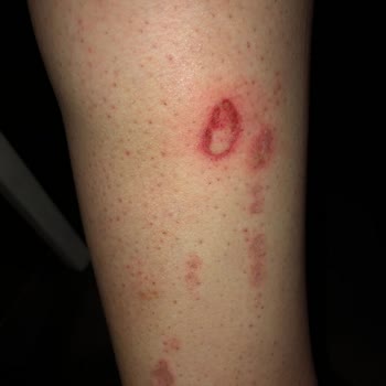 Philips Lumea Brı950 Bacağımı Yaktı