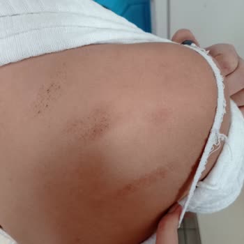 Liparis Güzellik Salonu Lazerde Kalıcı Yanıklar Oluştu