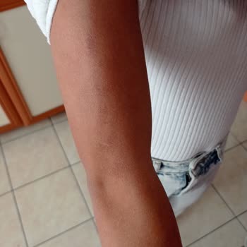 Liparis Güzellik Salonu Lazerde Kalıcı Yanıklar Oluştu