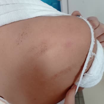 Liparis Güzellik Salonu Lazerde Kalıcı Yanıklar Oluştu