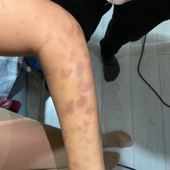 Aris Çukurambar Vip Lazer Sonrası Yanık Oluştu