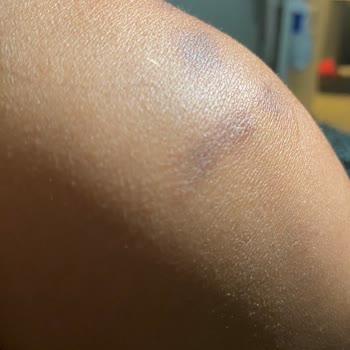 Aris Çukurambar Vip Lazer Sonrası Yanık Oluştu