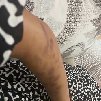 Aris Çukurambar Vip Lazer Sonrası Yanık Oluştu