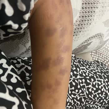 Aris Çukurambar Vip Lazer Sonrası Yanık Oluştu