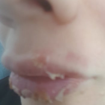 Eylül Berberoğlu Dudak Dolgu İşlemi Sonrası Ağrı Ve Şişlik Yaşadım, Para İadesi Talep Ediyorum