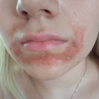 La Roche - Posay Yüzümde Yanık İzi Oluştu