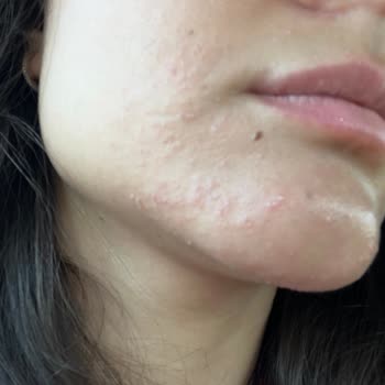 Maruderm Yüz Yıkama Jeli İlk Kullanımda Yüzümü Mahvetti