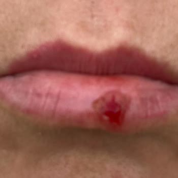 Bi'Güzellik Beauty Room Kaş ,Dudak İşlemi