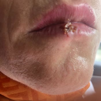 Bi'Güzellik Beauty Room Kaş ,Dudak İşlemi