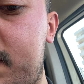 Yves Rocher Yüzümde Yanma Ve Kırmızılık Oldu